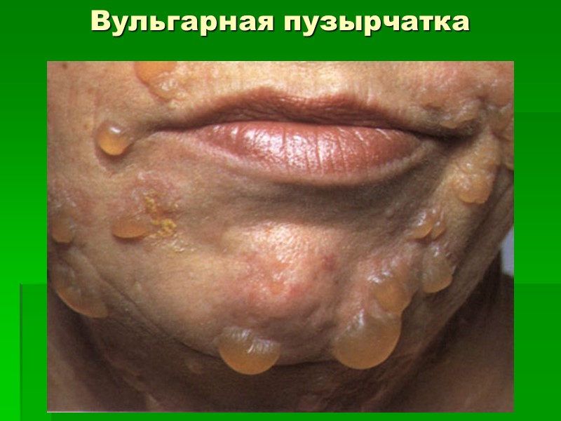 Вульгарная пузырчатка